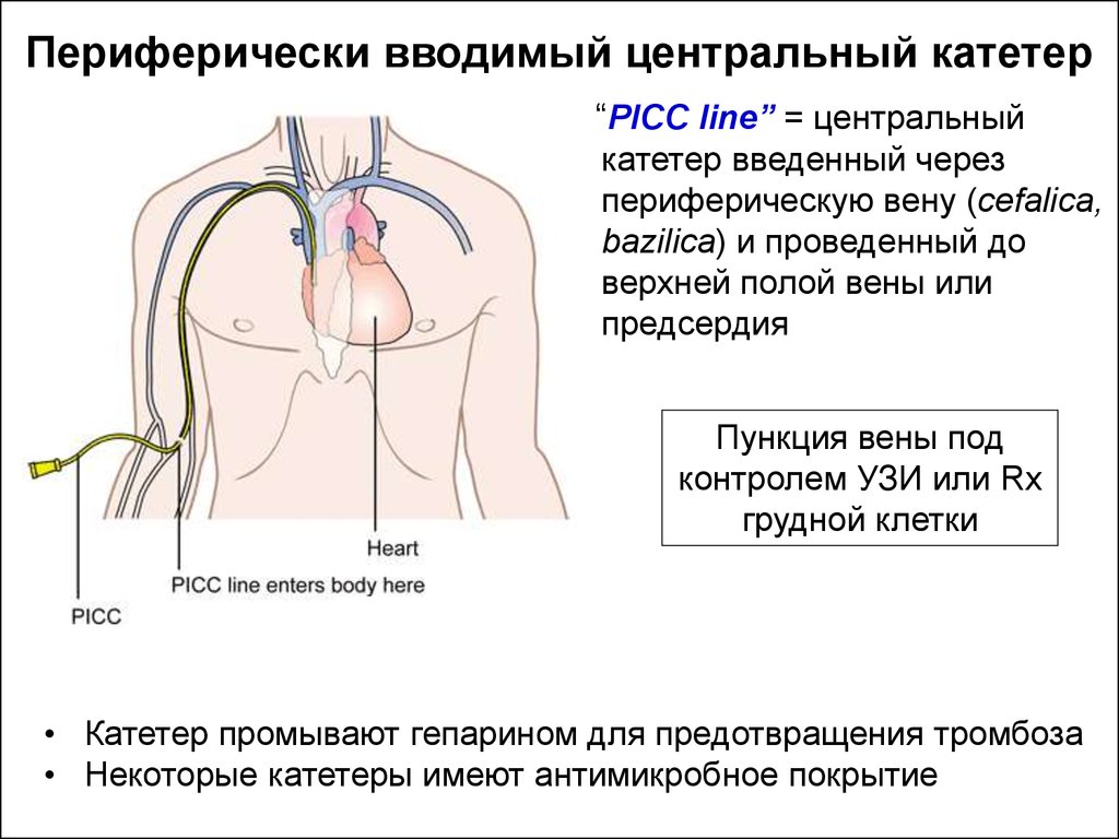 Катетер в яремной вене. Периферический и Центральный венозный катетер. Центральный венозный катетер рентген контроль. Катетер в подключичную Вену. Подключичная Вена катетеризация.