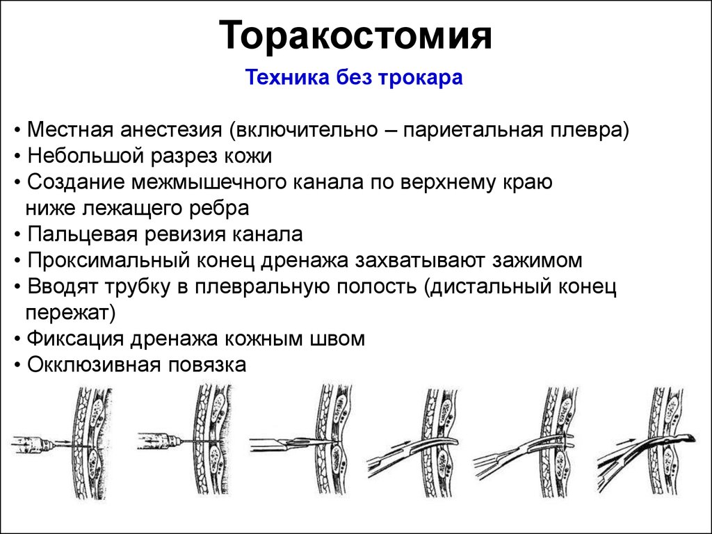 Техника без. Зондовая торакостомия. Хирургические манипуляции. Хирургическая манипуляция и операция различия.