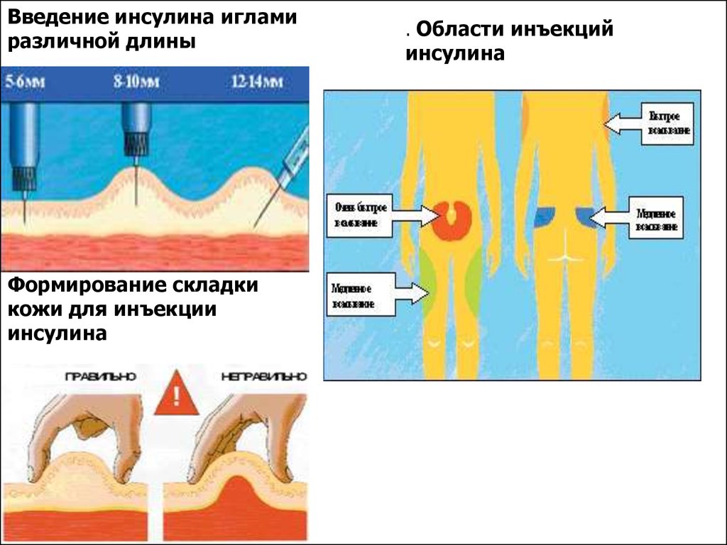 После инъекций инсулина пациент страдающий. Алгоритм проведения подкожного введения инсулина. Алгоритм выполнения подкожной инъекции инсулина. Алгоритм введения инсулина подкожно шприцем. Техника введения инсулина шприц ручкой детям.