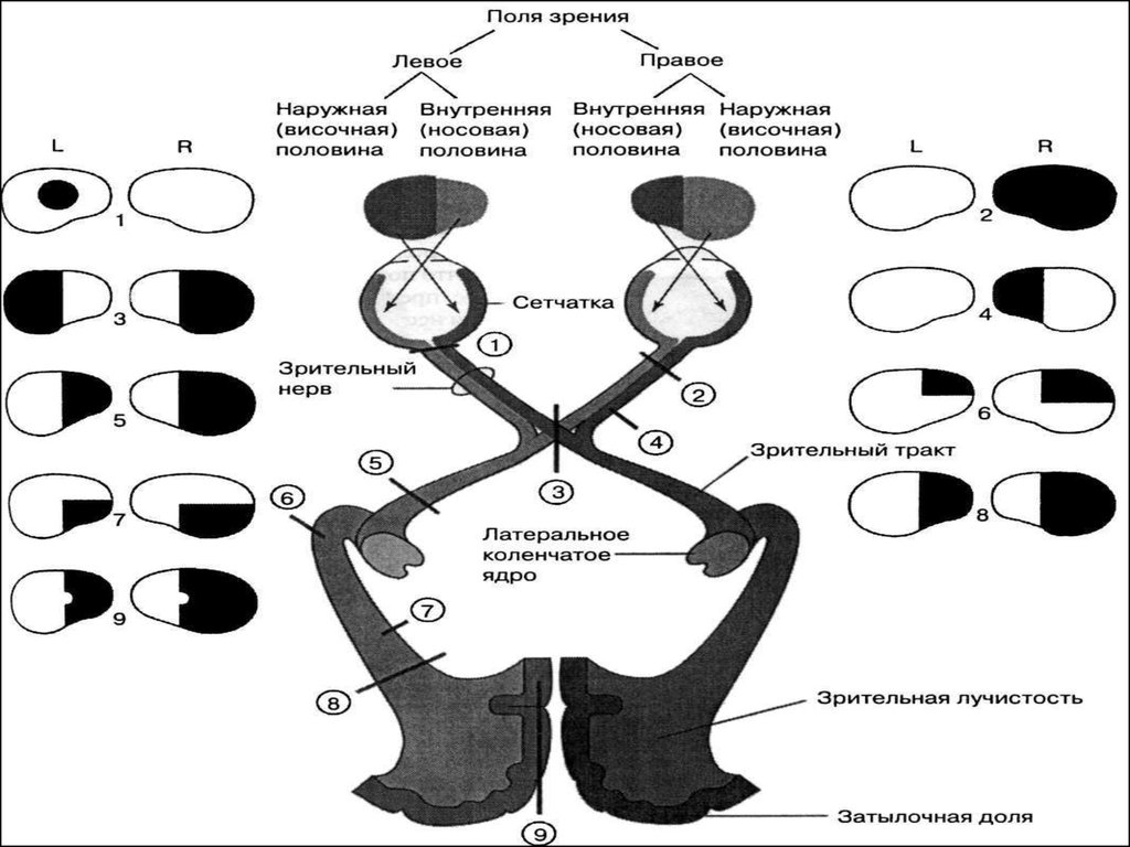 Анализатор поля зрения. Зрительный нерв неврология схема. Повреждение зрительного нерва. Схема зрительный анализатор места поражения. Зрительный анализатор поле зрения.