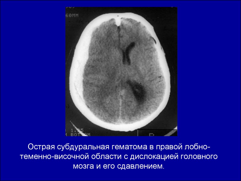Острая субдуральная гематома в правой лобно-теменно-височной области с дислокацией головного мозга и его сдавлением.