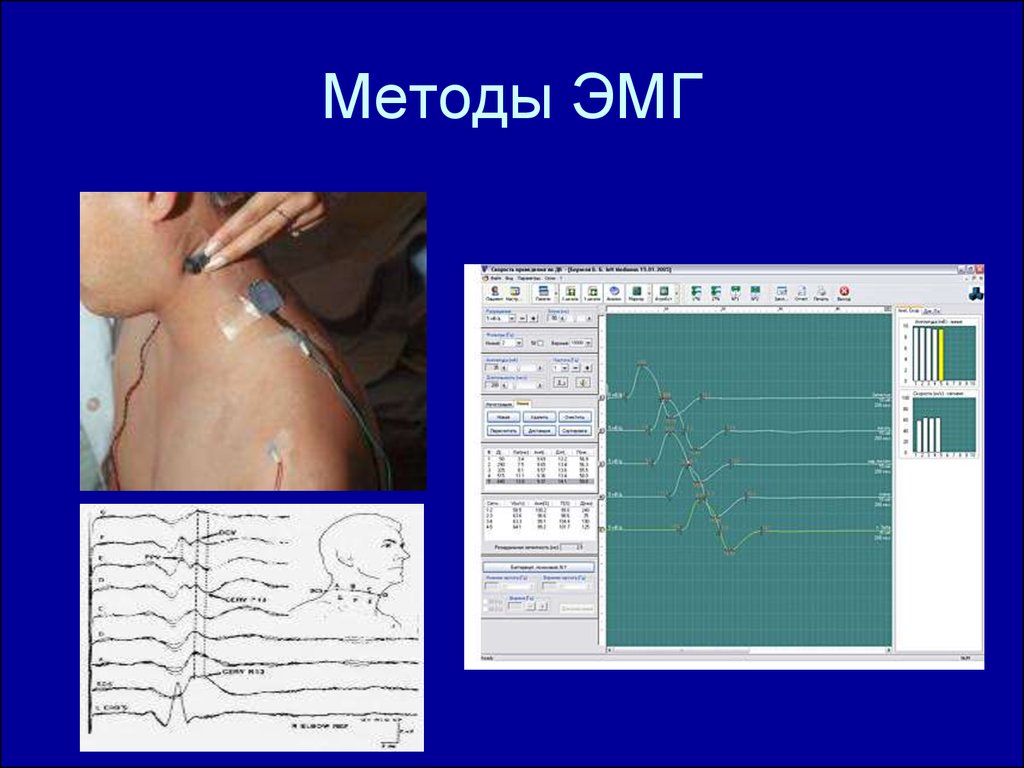 Энмг верхних конечностей. Неврология метод исследования ЭМГ ЭНМГ Беккера. Метод электромиографии. Методика ЭМГ электромиограмма.