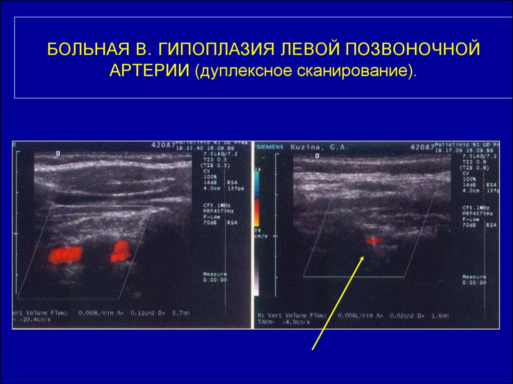 Гипоплазия левой. Гипоплазия позвоночных артерий по УЗИ. Гипоплазия v4 позвоночной артерии. УЗДГ сосудов гипоплазия позвоночной артерии. Гипоплазия v4 сегмента позвоночной артерии.