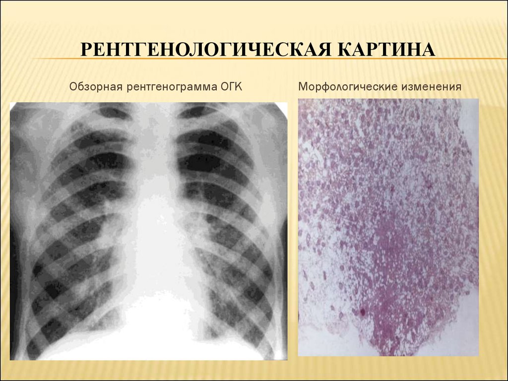 Рентгенологическая картина. Саркоидоз рентгенологический атлас. Первичный диссеминированный туберкулез рентген. Обзорная рентгенограмма ОГК. Первичный туберкулезный комплекс рентгенологическая картина.