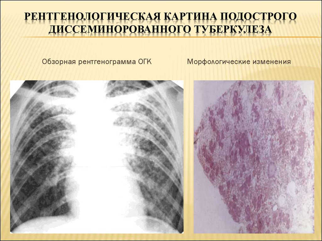 Диссеминированный туберкулез фаза инфильтрации. Подострый диссеминированный туберкулез рентген. Милиарный диссеминированный туберкулез рентген. Лимфогенный диссеминированный туберкулез рентген. Подострый милиарный туберкулез.