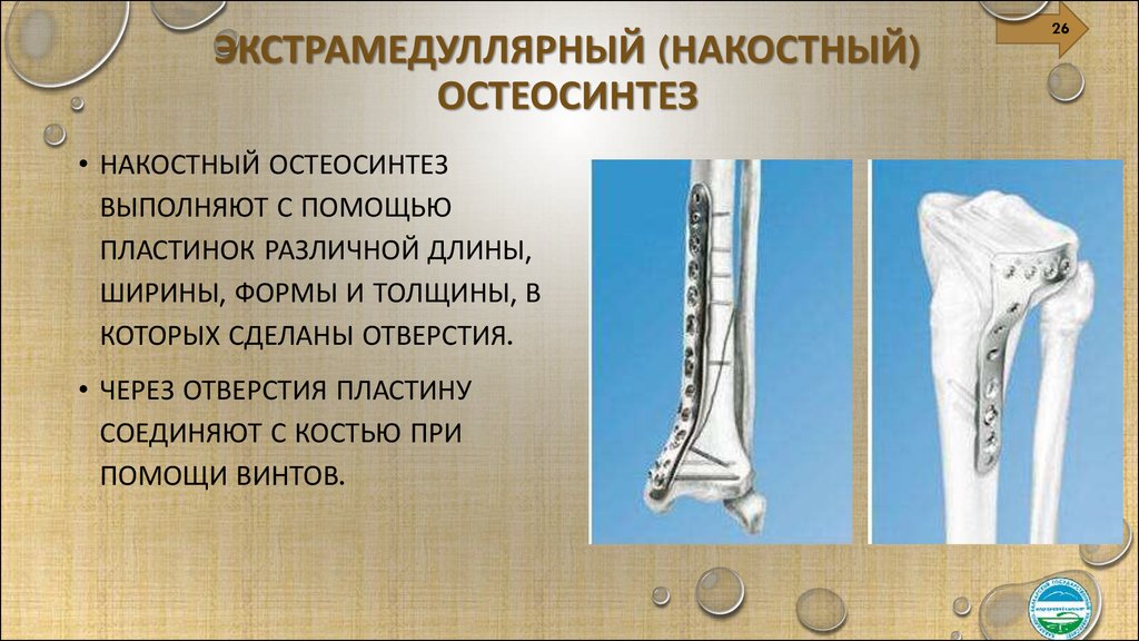 Этапы лечения переломов. Экстрамедуллярный (накостный) остеосинтез. Перелом плечевой кости экстрамедуллярный остеосинтез. Интрамедуллярный (внутрикостный) остеосинтез. Накостный остеосинтез травматология.