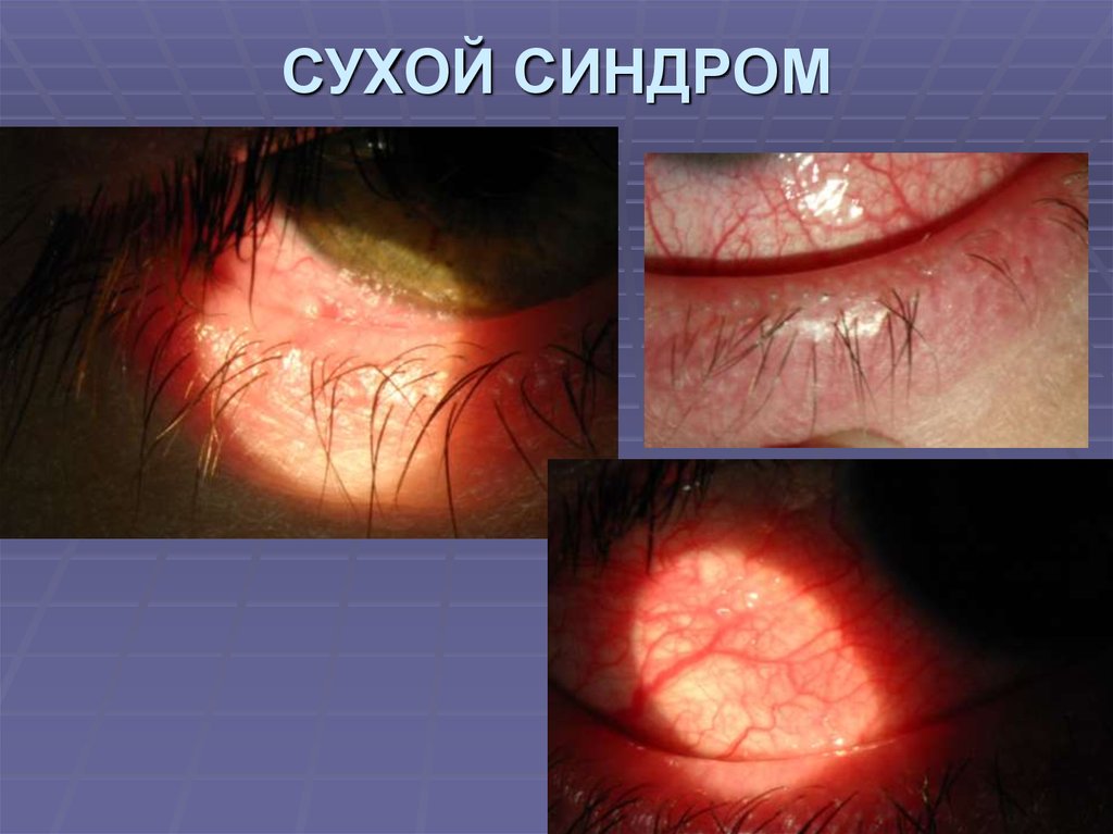 СУХОЙ СИНДРОМ
