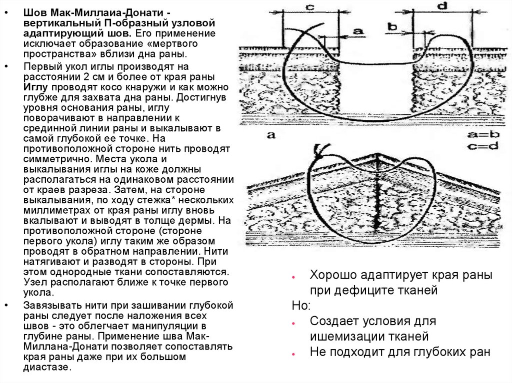 Шов донати схема