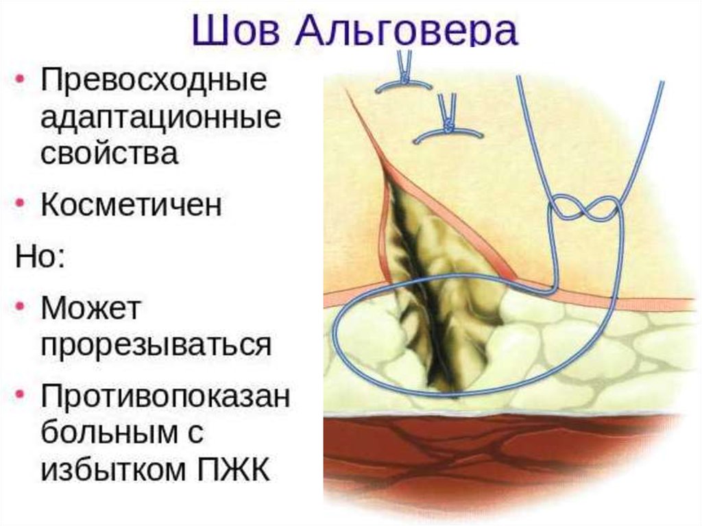 Шов донати схема