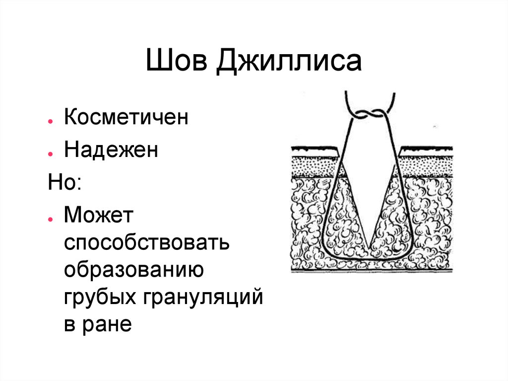 Шов донати схема