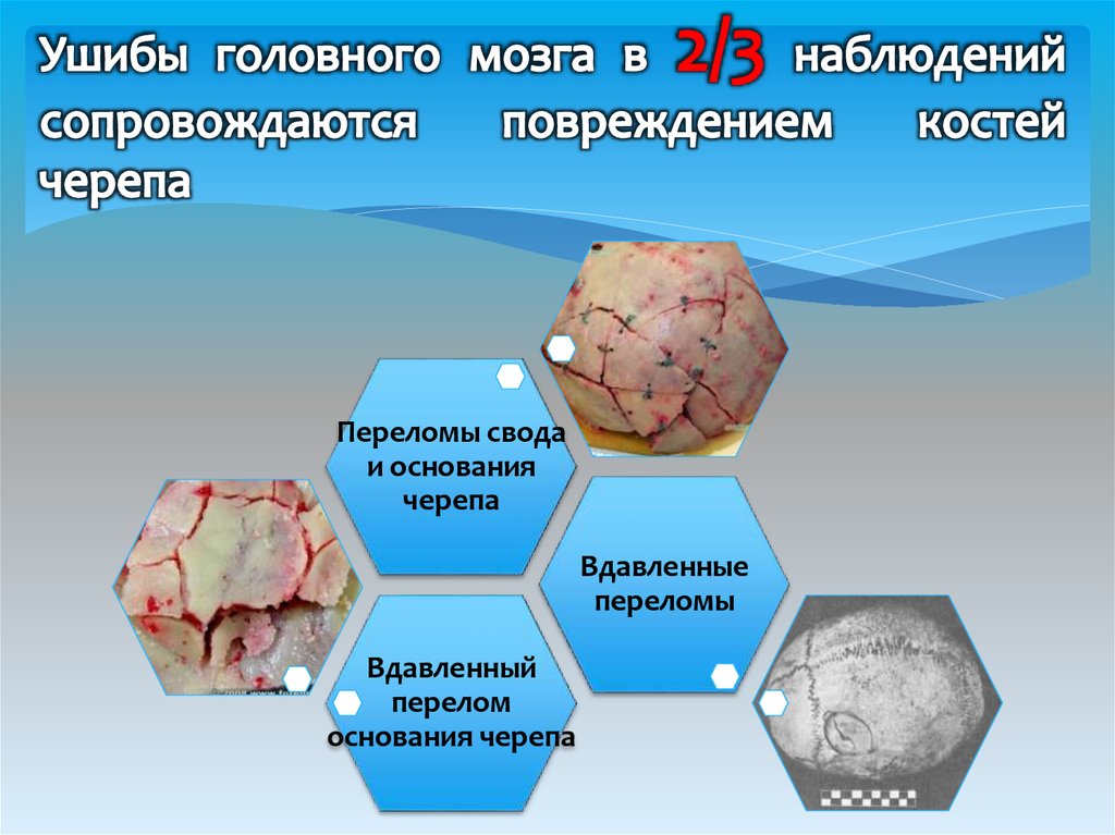 Разрыв костного мозга