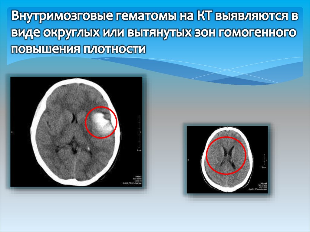 Гематома черепно мозговой травме. Хроническая внутримозговая гематома на кт. Кт внутримозговая гематома головного мозга. Внутримозговая гематома классификация кт. Подострая внутримозговая гематома на кт.