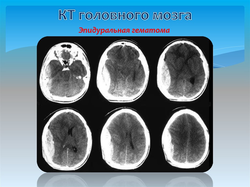 Эпидуральная гематома на кт