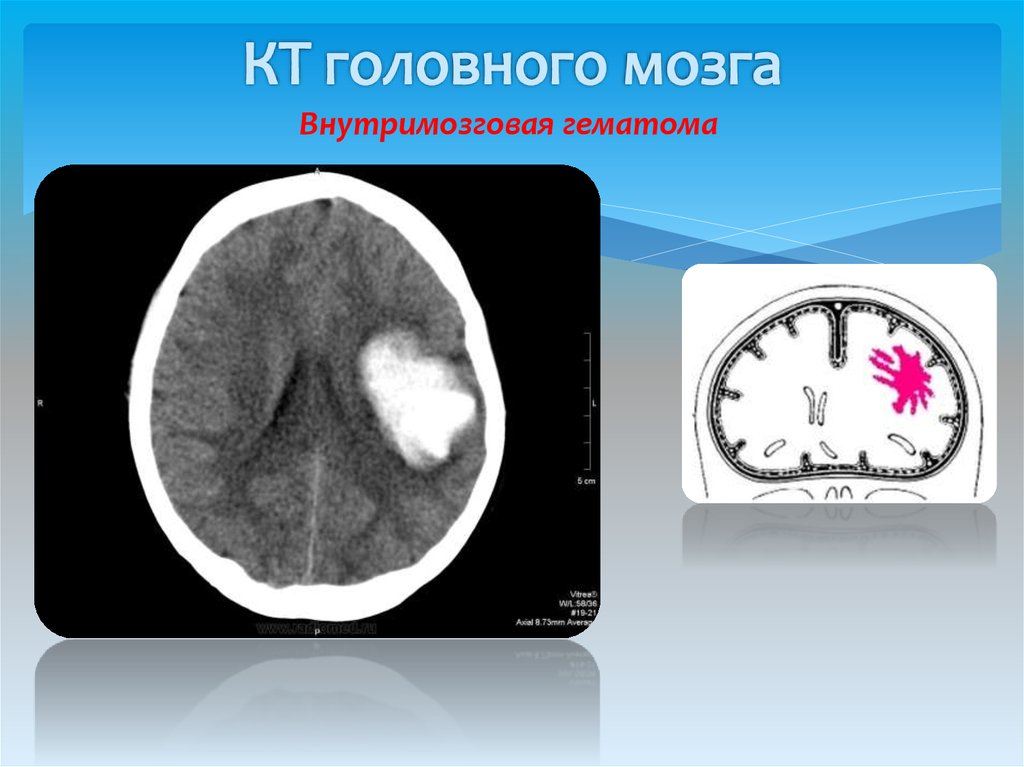 Гематома черепно мозговой травме. Эпидуральная гематома на кт. Объем эпидуральной гематомы. Внутримозговая гематома кт. Гематома головного мозга кт.