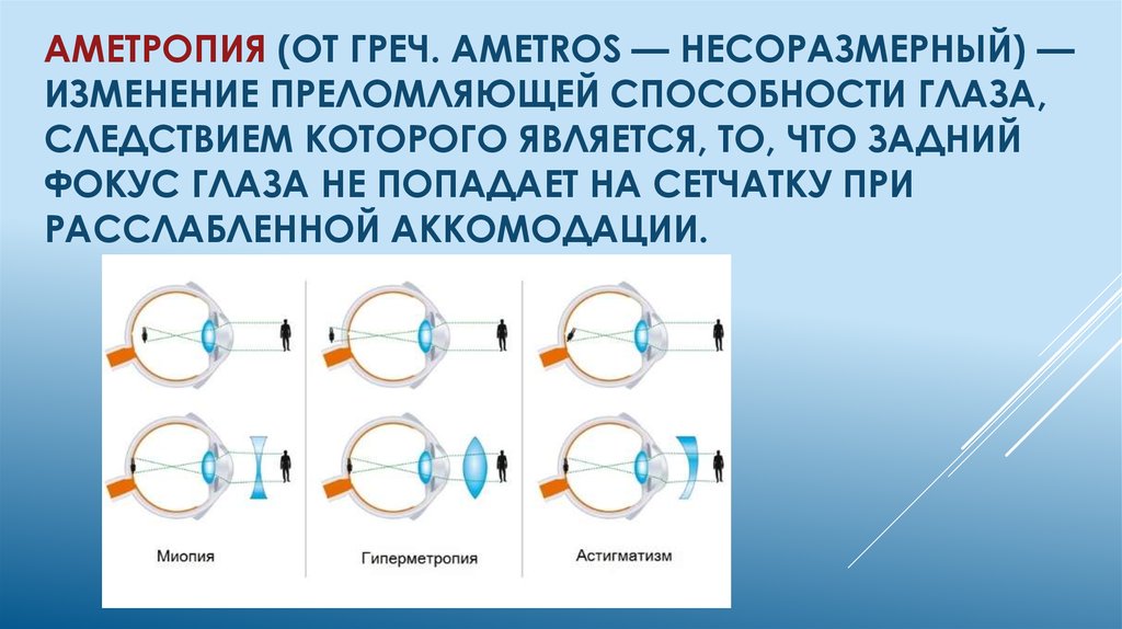 Фокусировка лучей попадающих в глаз от удаленного предмета картинка