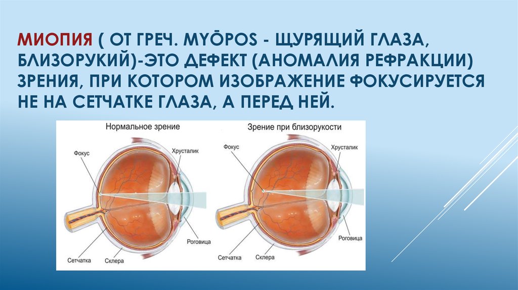 Где находится изображение предмета в близоруком глазу