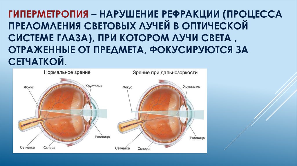 Рефракция глаза характеристика изображения на сетчатке