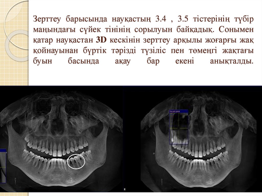 Зерттеу барысында науқастың 3.4 , 3.5 тістерінің түбір маңындағы сүйек тінінің сорылуын байқадық. Сонымен қатар науқастан 3D кескінін зерттеу 