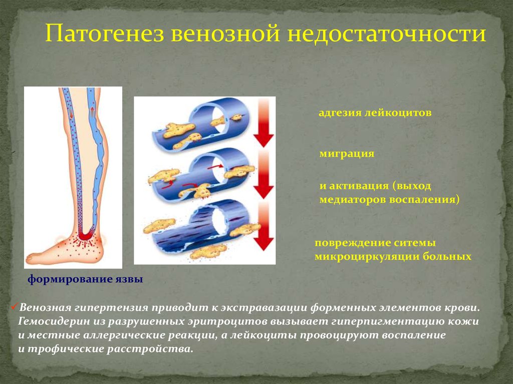 Недостаточность клапанов нижних конечностей