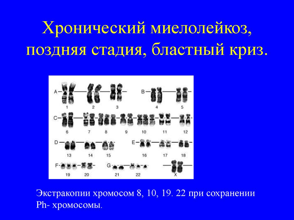 8 хромосома. Хронический миелолейкоз кариотип. Хронический миелолейкоз бластный криз. Хронический миелолейкоз в стадии бластного криза. Делеция в восьмой хромосоме.