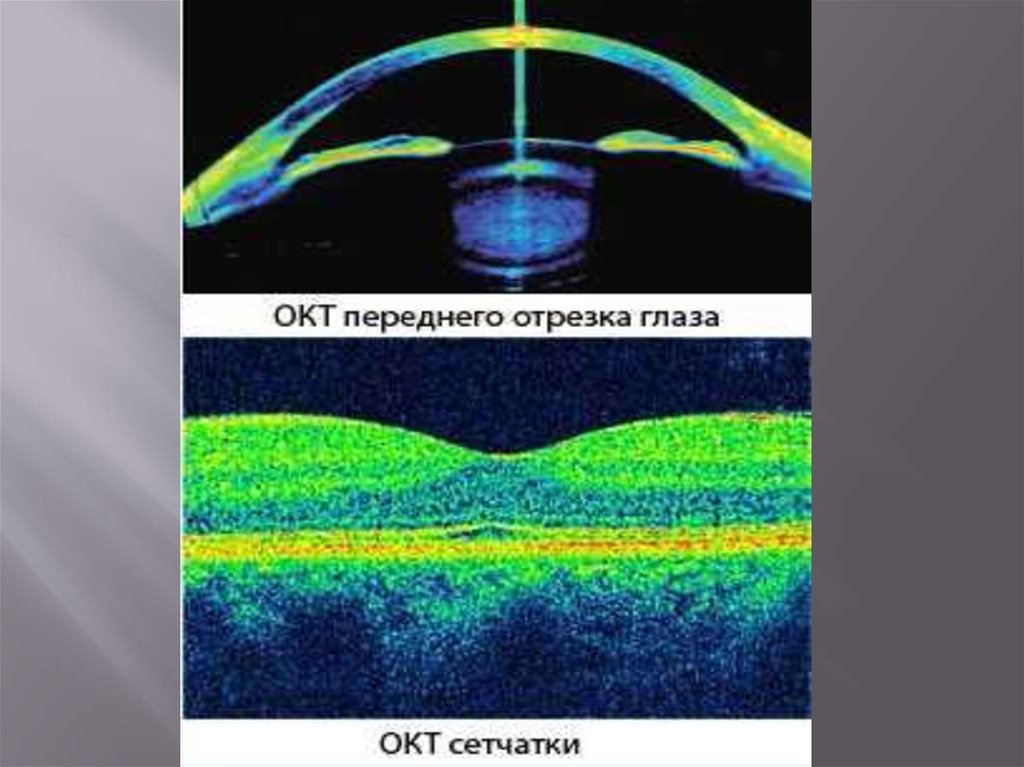 Окт. Оптическая когерентная томография сетчатки. Оптическая когерентная томография переднего отрезка глаза. Оптическая когерентная томография норма. Оптическая когерентная томография (окт) заднего отрезка.