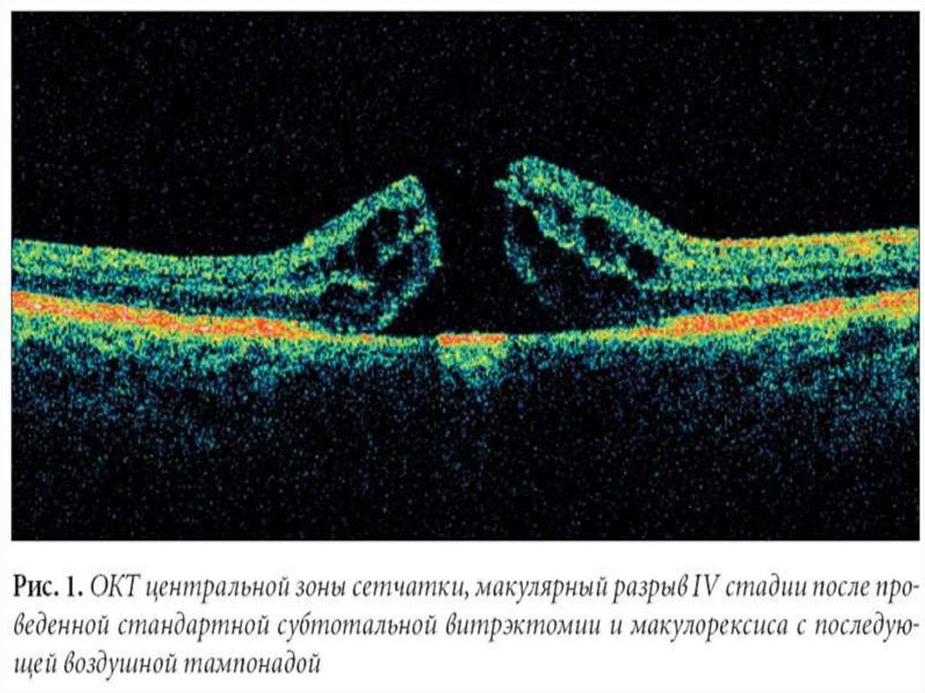 Оптическая томография. Когерентная томография сетчатки глаза. Оптическая когерентная томография (окт) заднего отрезка. Оптическая когерентная томография сетчатки глаза. Окт сетчатки норма.