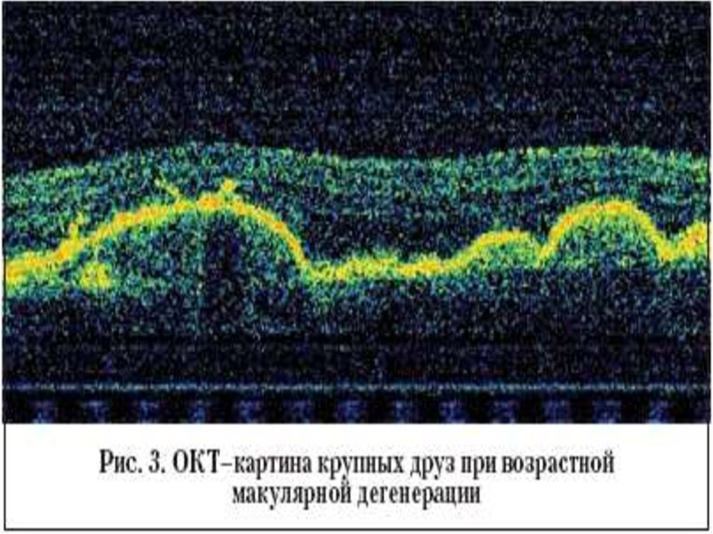 Окт. Оптическая когерентная томография макулы. ВМД на оптической когерентной томографии. Макулярная зона окт. Оптическая когерентная томография друзы диска.