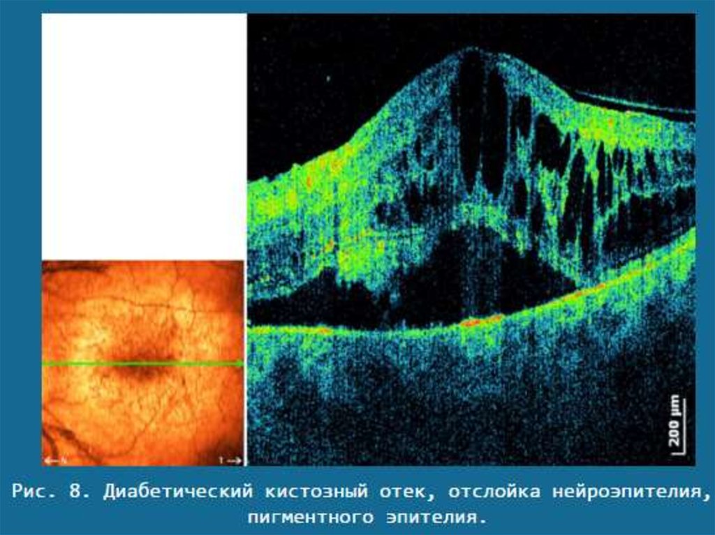 Оптическая томография. Оптическая когерентная томография диабетическая ретинопатия. Отслойка нейроэпителия сетчатки на окт. Диабетический макулярный отек окт. Окт отслойка пигментного эпителия.