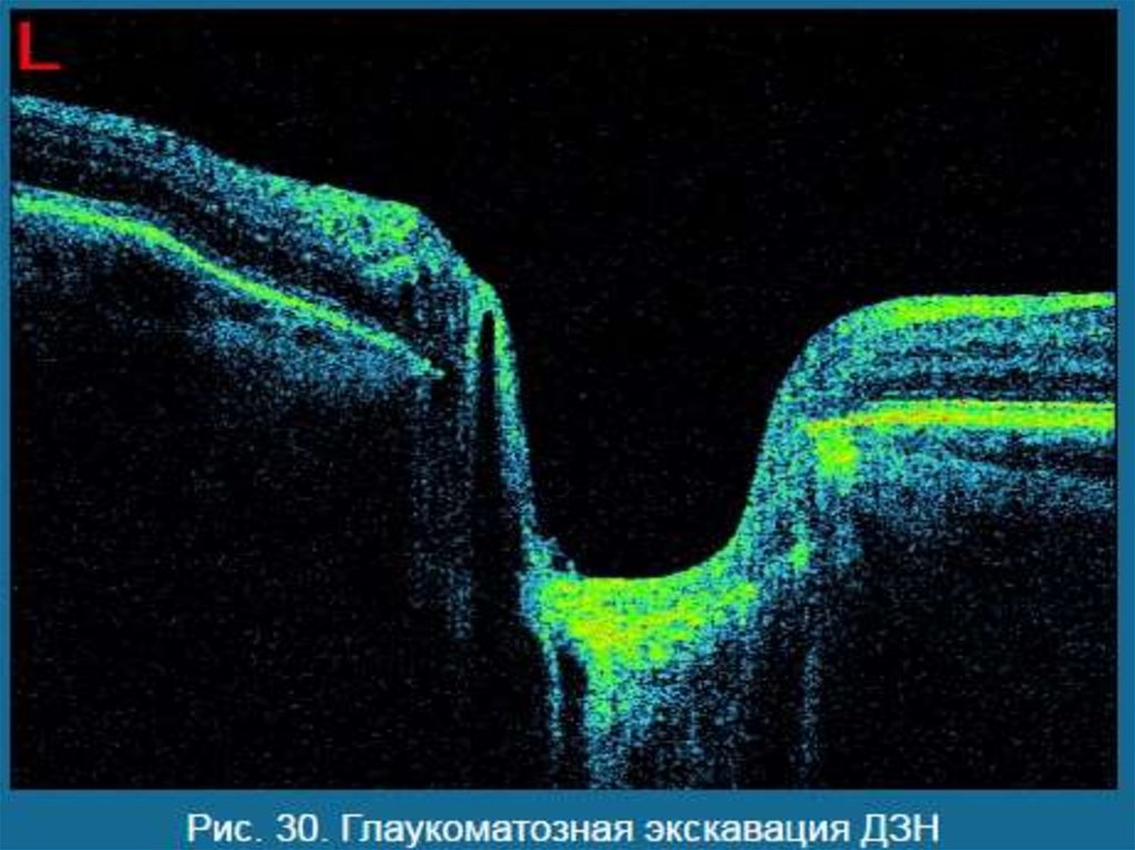 Оптическая когерентная томография (ОСТ) зрительного нерва. Оптическая когерентная томография при глаукоме. Томография диска зрительного нерва. Оптическая когерентная томография в гинекологии.