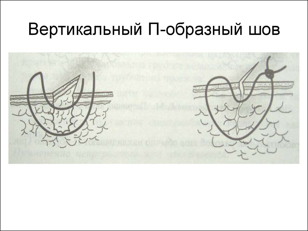 Шов донати схема