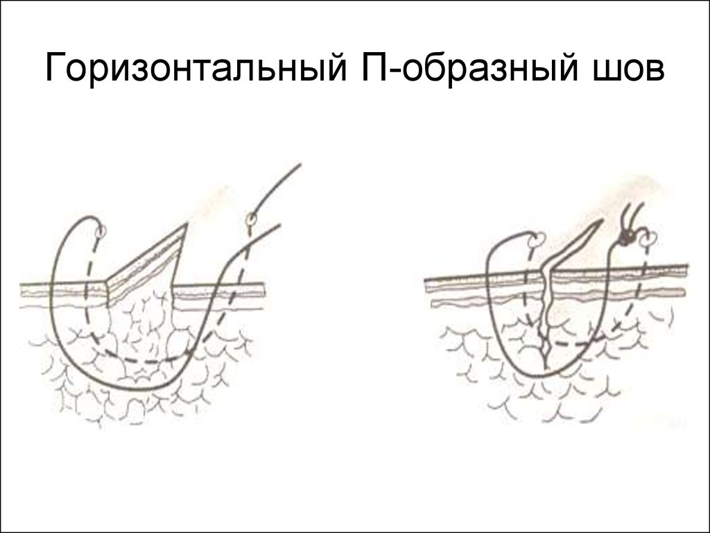 Шов донати схема