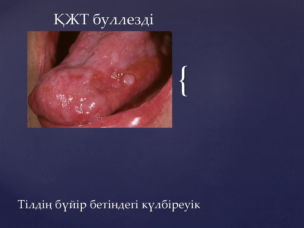 ҚЖТ буллезді