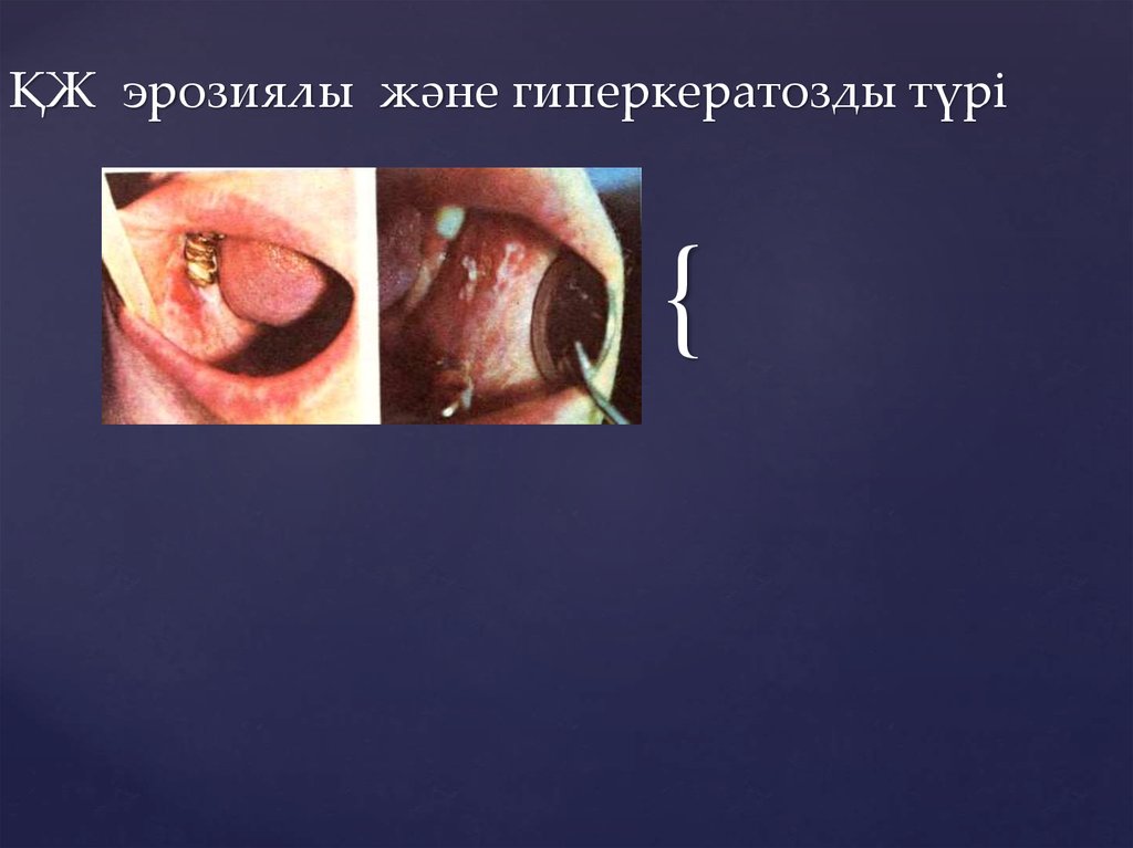 ҚЖ эрозиялы және гиперкератозды түрі