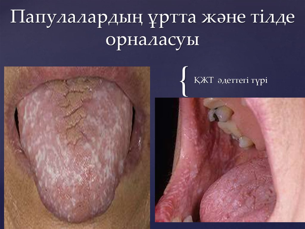 Папулалардың ұртта және тілде орналасуы