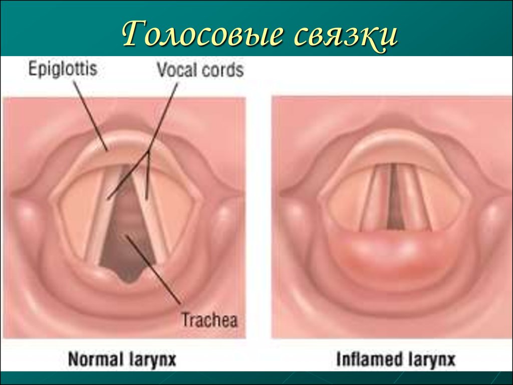 Как лечить ларингит. Флегмонозный ларингит. Острый катаральный ларингит. Гипертрофический ларингит.