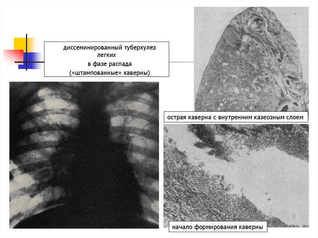 Фаза распада легких. Хронический гематогенно диссеминированный туберкулез рентген. Острый диссеминированный туберкулез легких рентген. Крупноочаговый диссеминированный туберкулез. Диссеминированный туберкулез аускультация.