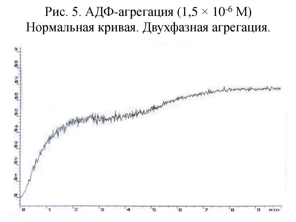 Рис. 5. АДФ-агрегация (1,5 × 10-6 М) Нормальная кривая. Двухфазная агрегация.
