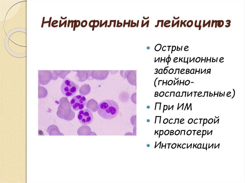 Лейкоцитоз нейтрофилез. При острых инфекционных заболеваниях число лейкоцитов в крови. Нейтрофильный лейкоцитоз при. Лейкоцитоз при инфекционных заболеваниях. Типы нейтрофильных лейкоцитозов..