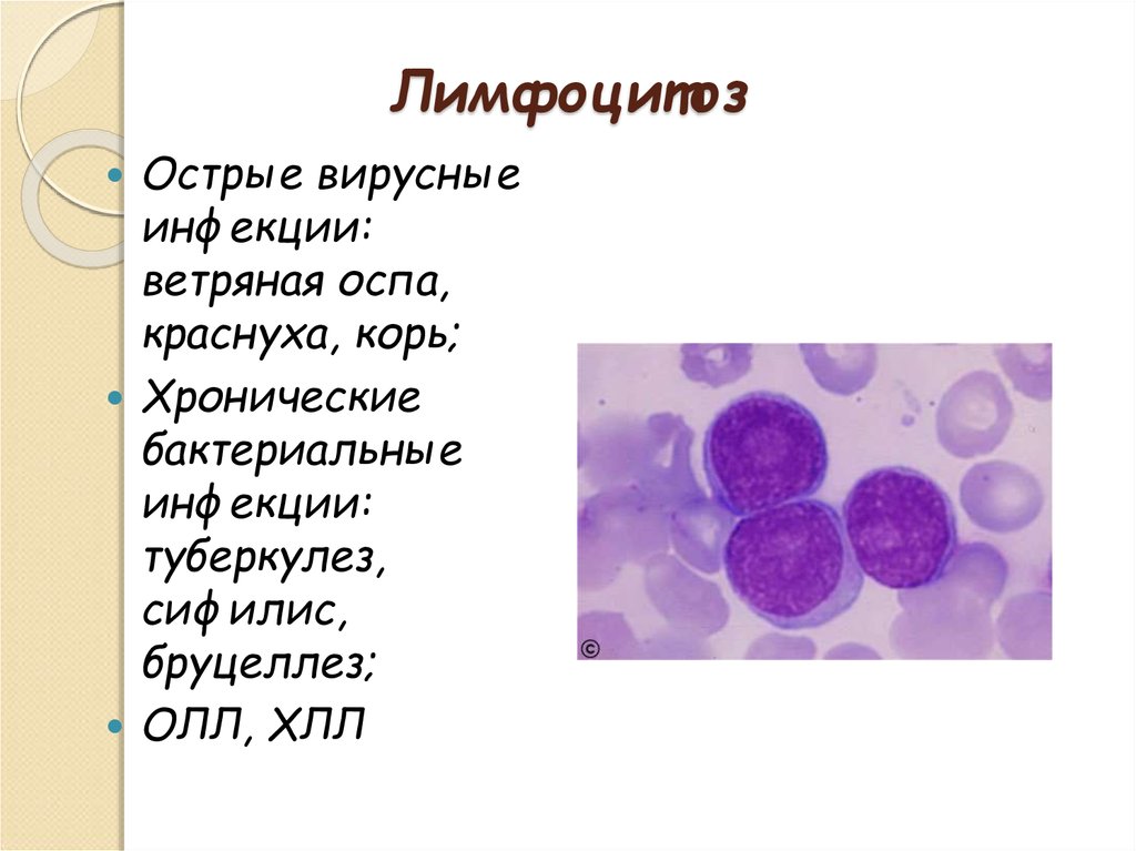 Лимфоцитоз лимфопения. Лимфоцитоз вирусная инфекция. Относительный лимфоцитоз. Limfotsitopoez. Абсолютный лимфоцитоз.