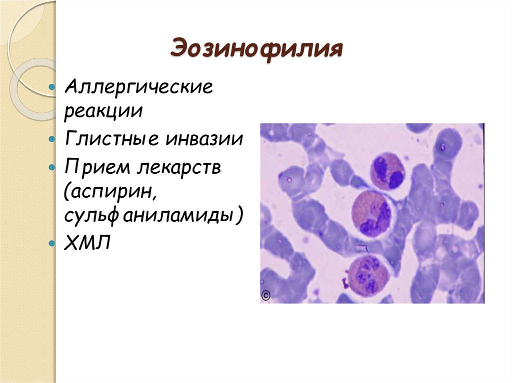 Кровь эозинофилы 10. Эозинофилия периферической крови. Лейкоцитоз эозинофилия. Эозинофилия характерна для. Эозинофилия в периферической крови наблюдается при.