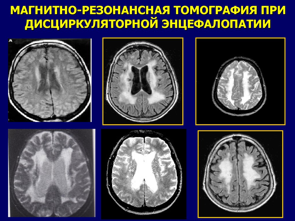 Дисциркуляторной энцефалопатии головного мозга у взрослых что. Энцефалопатия головного мозга на кт. Кт картина дисциркуляторная энцефалопатия. Дисциркуляторная энцефалопатия на кт на кт. Лейкоэнцефалопатия головного мозга кт.
