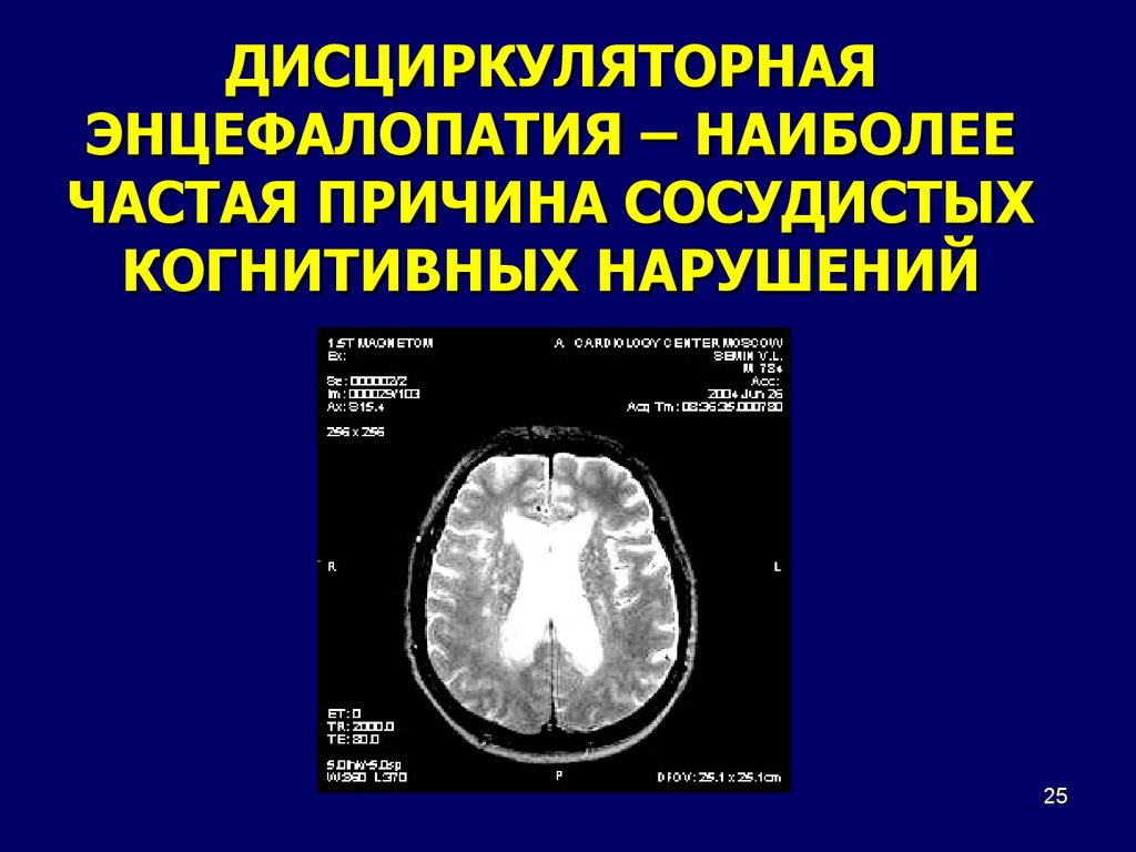 Дисциркуляторные изменения головного мозга что это такое. Дисциркуляторная энцефалопатия. Дисциркуляторная энцефалопатия когнитивные нарушения. Энцефалопатия с когнитивными нарушениями. Дисциркуляторная энцефалопатия на кт.