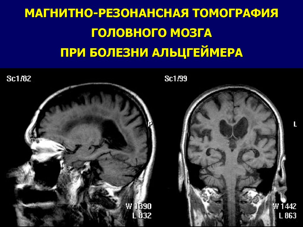 Дисциркуляторные изменения головного мозга что это такое. Дисциркуляторная энцефалопатия на кт. Энцефалопатии Вернике СКТ. Дисциркуляторная энцефалопатия мрт. Дисциркуляторная энцефалопатия головного мозга на кт.