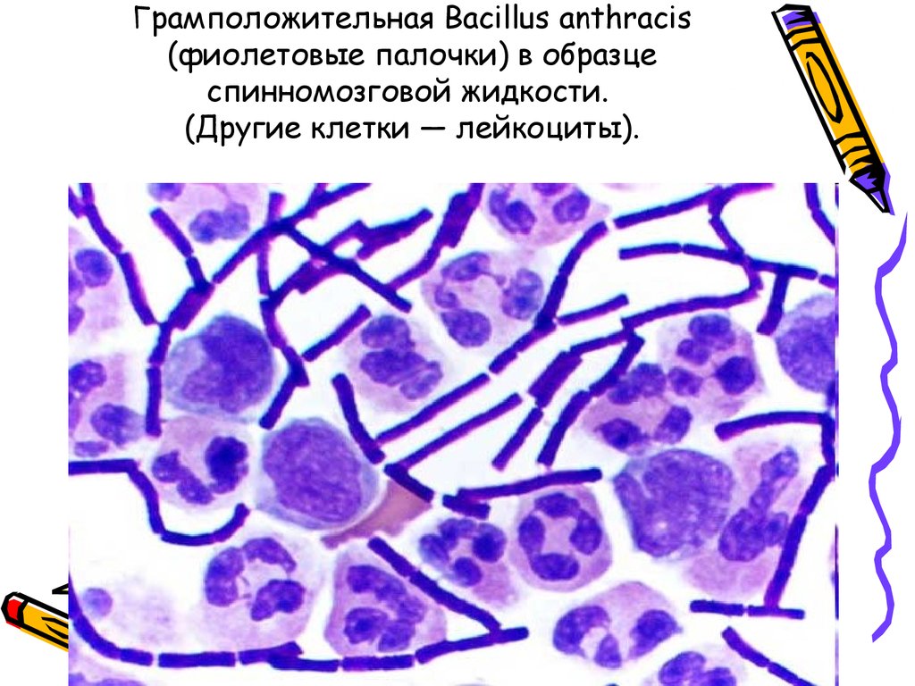 Грамположительная Bacillus anthracis (фиолетовые палочки) в образце cпинномозговой жидкости. (Другие клетки — лейкоциты).