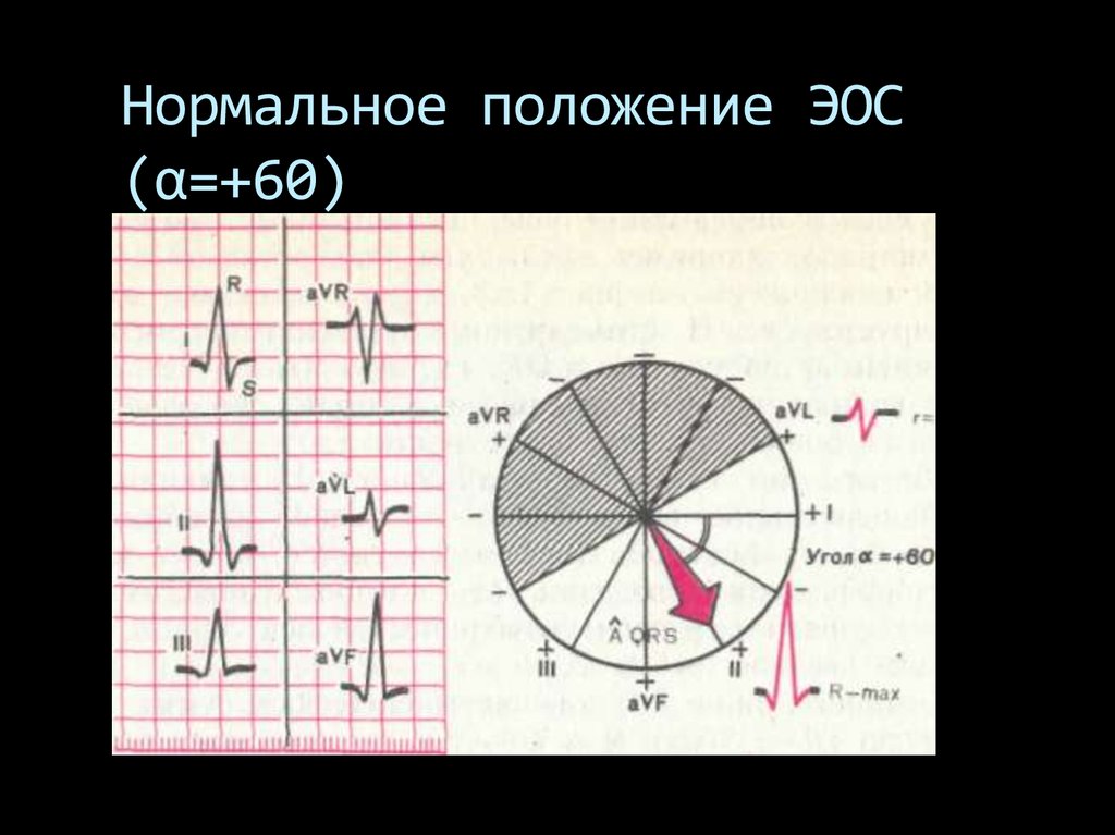 Вертикальная эос. Нормальное положение электрической оси. Нормальное положение ЭОС угол Альфа. Рисунок нормальное положение ЭОС. Признаки нормального положения ЭОС.