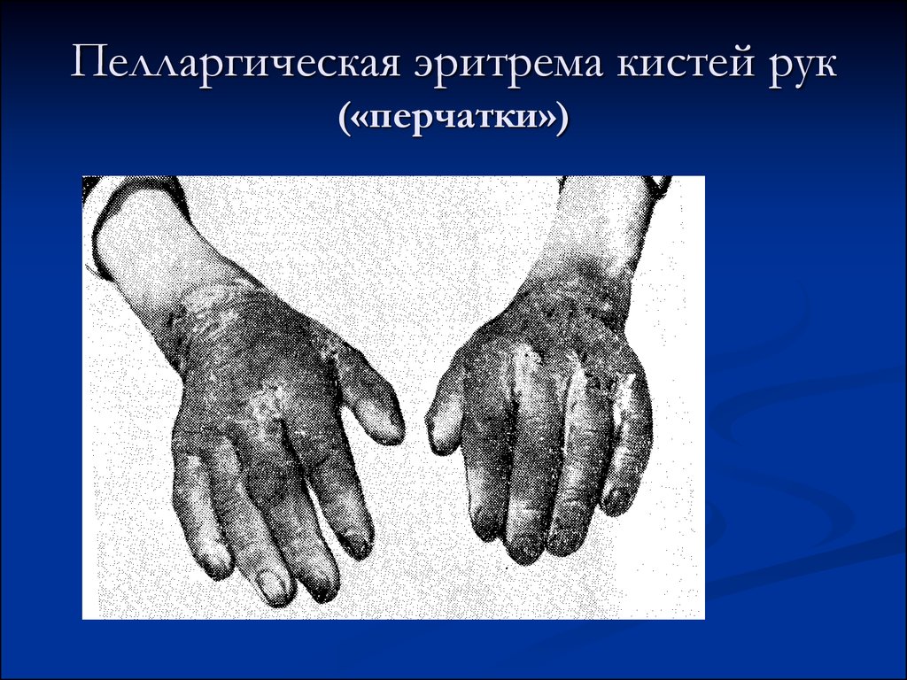 Пелларгическая эритрема кистей рук («перчатки»)