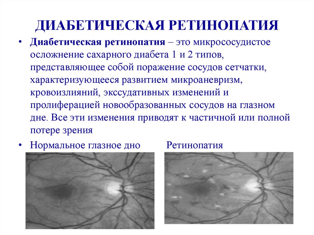 Изменение глазного дна при сахарном диабете презентация