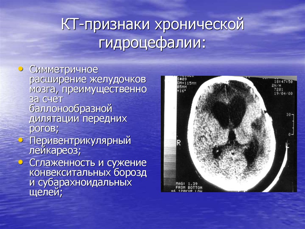 Дилатация бокового желудочка мозга