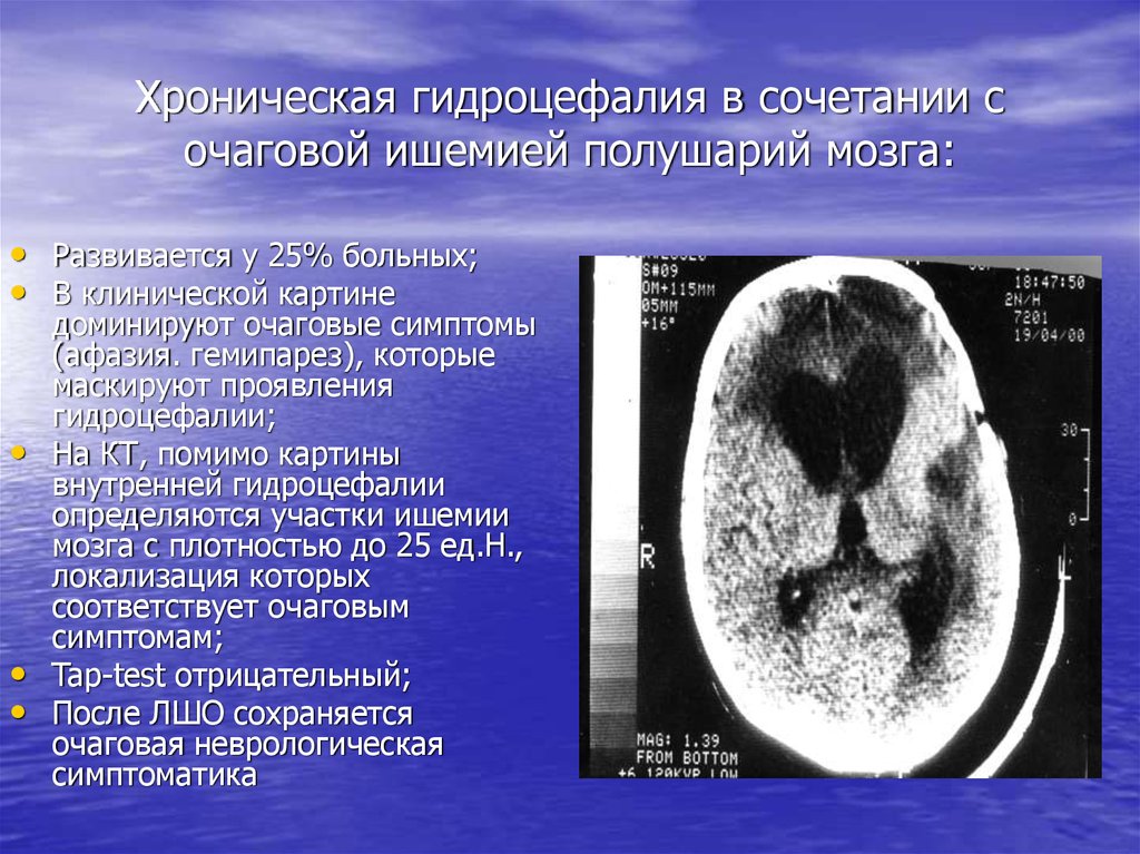 Очаговые изменения больших полушарий. Ишемическое повреждение головного мозга. Хроническая ишемия мозга на кт. Хроническая ишемия головного мозга на кт. Ишемическая гидроцефалия.