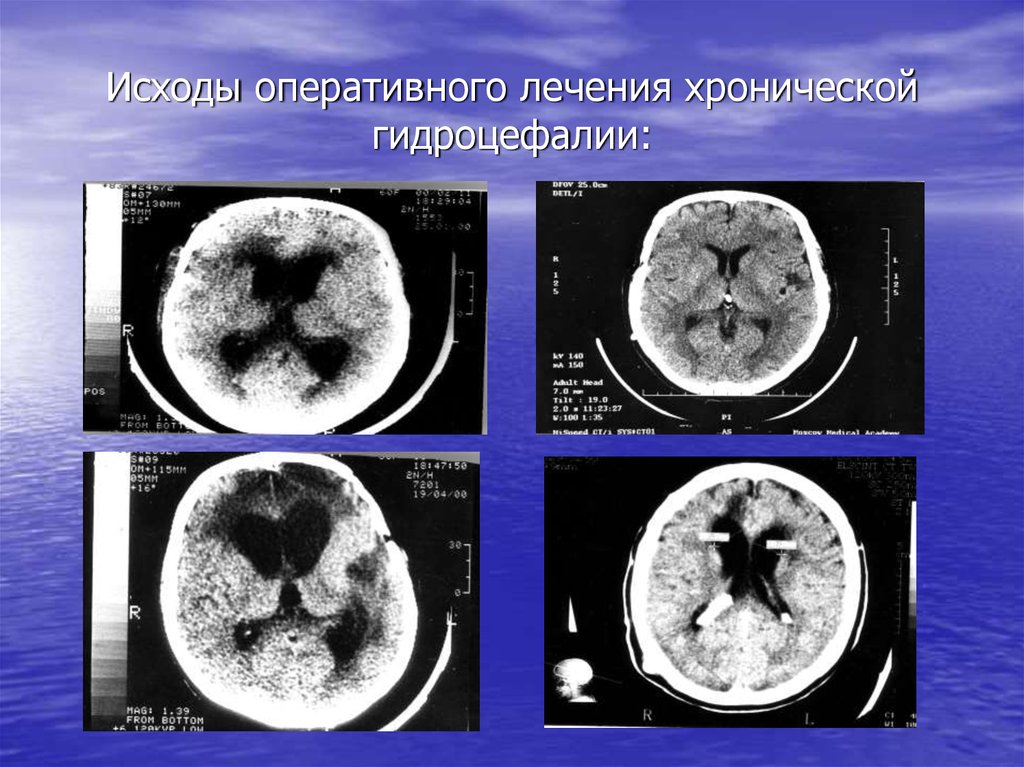 Последствия черепно мозговой травмы. После черепно мозговой травмы последствия. Самое опасное последствие черепно-мозговой травмы человека. Исходы закрытой черепно-мозговой травмы.